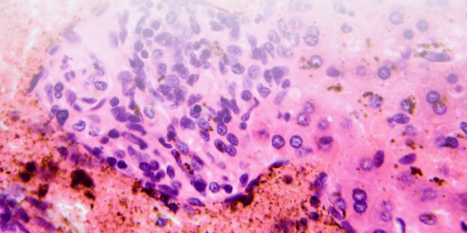 coccidiosis aviar